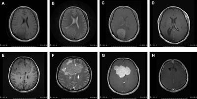 Clinical Features, Management, and Prognostic Factors of Intracranial Solitary Fibrous Tumor